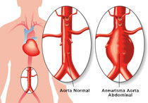 Aneurisma Aorta - Definisi, Penyebab, Diagnosis dan Pengobatan