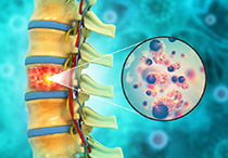 Tumor Tulang Belakang: Penyebab, Gejala, Jenis dan Cara Pengobatan