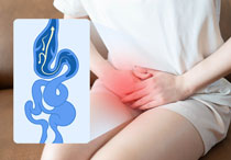 Pelvic Congestion Syndrome: Apa yang Perlu Kita Ketahui dan Bagaimana Cara Pengobatannya