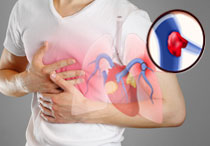 Emboli Paru: Penyebab, Gejala, Pengobatan, dan Pencegahannya