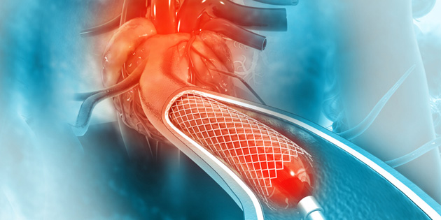 Pasang Ring Jantung: Manfaat, Prosedur, dan Perawatannya