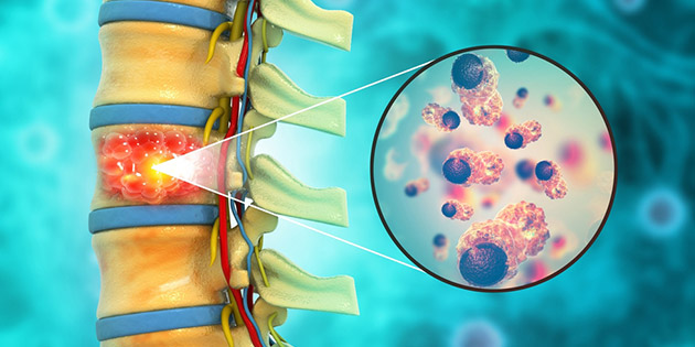 Tumor Tulang Belakang: Penyebab, Gejala, Jenis dan Cara Pengobatan