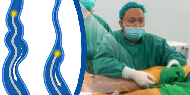 Prosedur EVLA untuk Pengobatan Varises: Cara Kerja & Keunggulannya