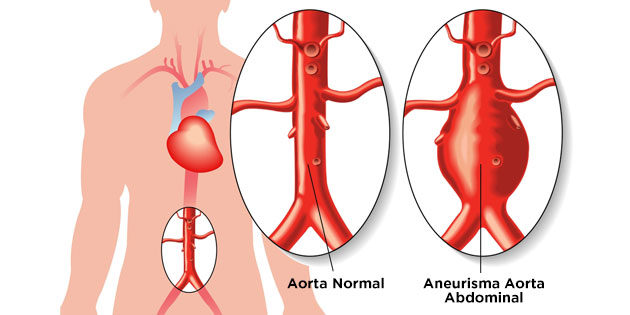 Aneurisma Aorta - Definisi, Penyebab, Diagnosis dan Pengobatan