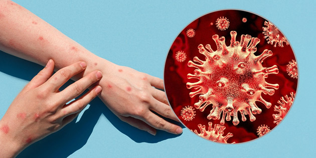 Ciri-Ciri Cacar Monyet yang Harus Anda Waspadai