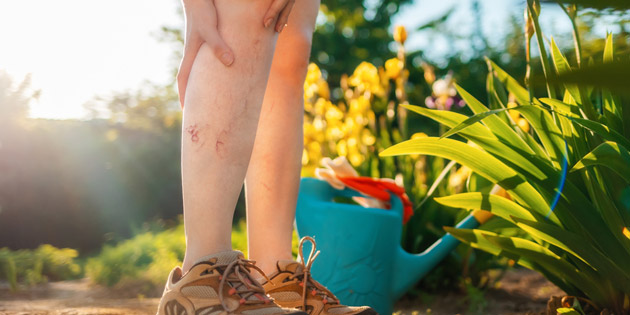 Kenali Penyebab Varises dan Pengobatannya