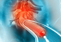 Pasang Ring Jantung: Manfaat, Prosedur, dan Perawatannya