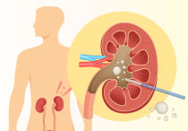 Mengenal Prosedur PCNL untuk Penyakit Batu Ginjal dan Keunggulannya