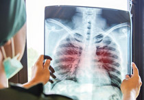 Penting Dipahami, Ini Gejala TBC dan Cara Penanganannya