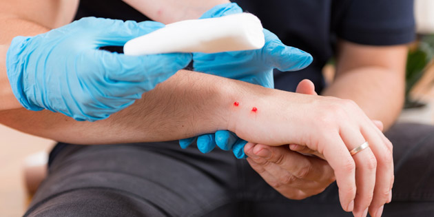 Ketahui Cara Melakukan Pertolongan Pertama Digigit Ular