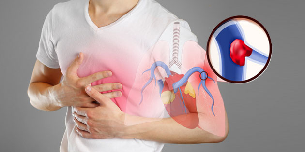 Emboli Paru: Penyebab, Gejala, Pengobatan, dan Pencegahannya