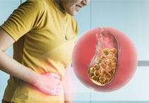 Penyakit Batu Empedu: Penyebab, Gejala, dan Pengobatan