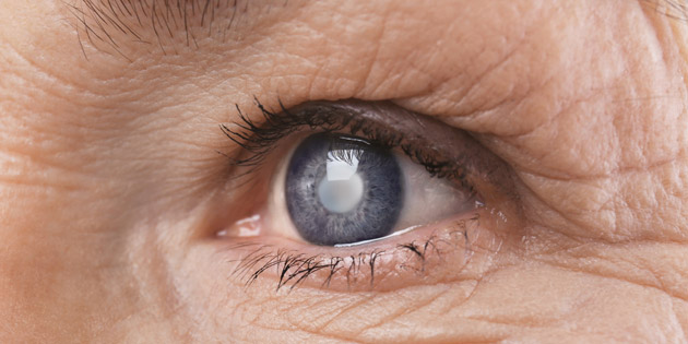 Mengenal Gejala dan juga Penyebab Terjadinya Mata Katarak