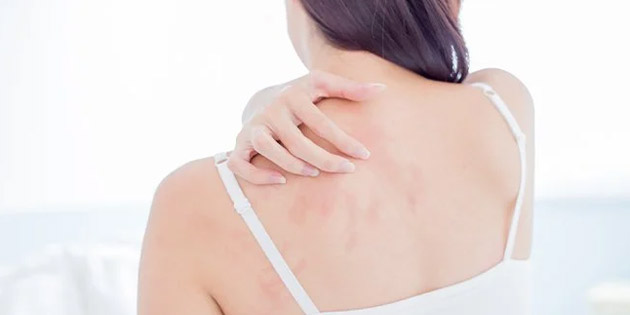 Apa itu Urtikaria atau Biduran?