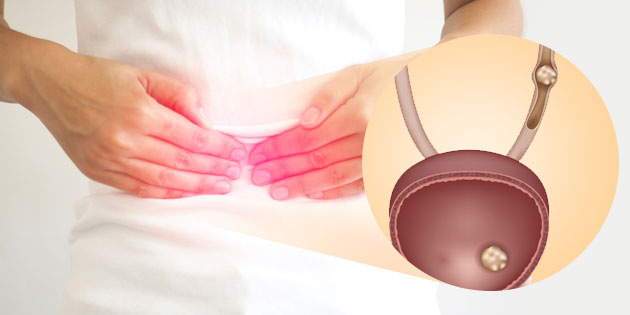 Batu Saluran Kemih: Definisi, Gejala, dan Pengobatan