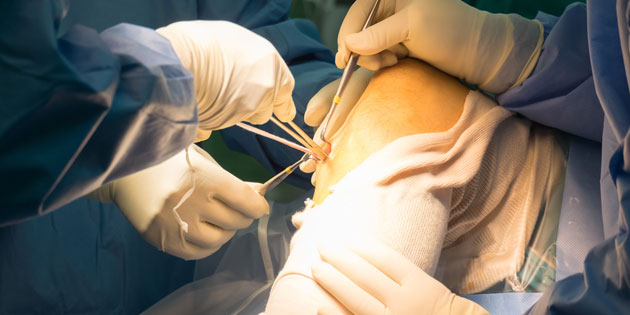 Penyebab Operasi ACL Harus Dilakukan dan Prosedurnya