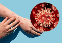 Ciri-Ciri Cacar Monyet yang Harus Anda Waspadai