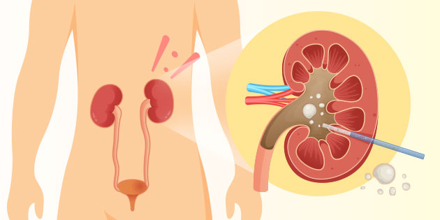 Mengenal Prosedur PCNL untuk Penyakit Batu Ginjal dan Keunggulannya