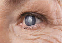 Mengenal Gejala dan juga Penyebab Terjadinya Mata Katarak